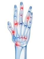 Punti di infiammazione dell'artrite nella mano